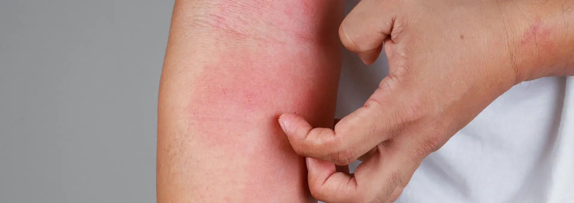 Une allergie sur le bras