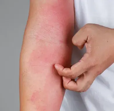 Une allergie sur le bras